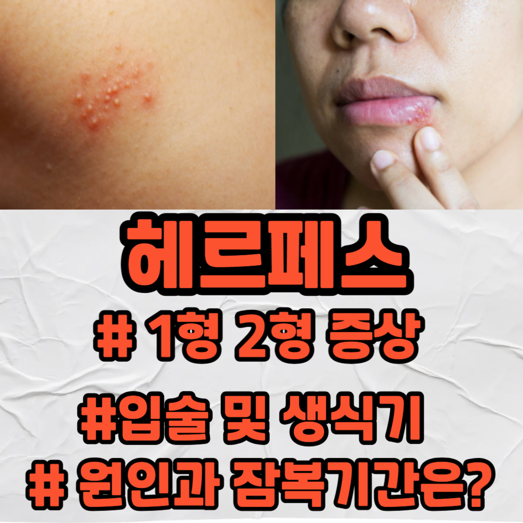 헤르페스 1형 2형 증상 입술 생식기 원인과 잠복기간은?